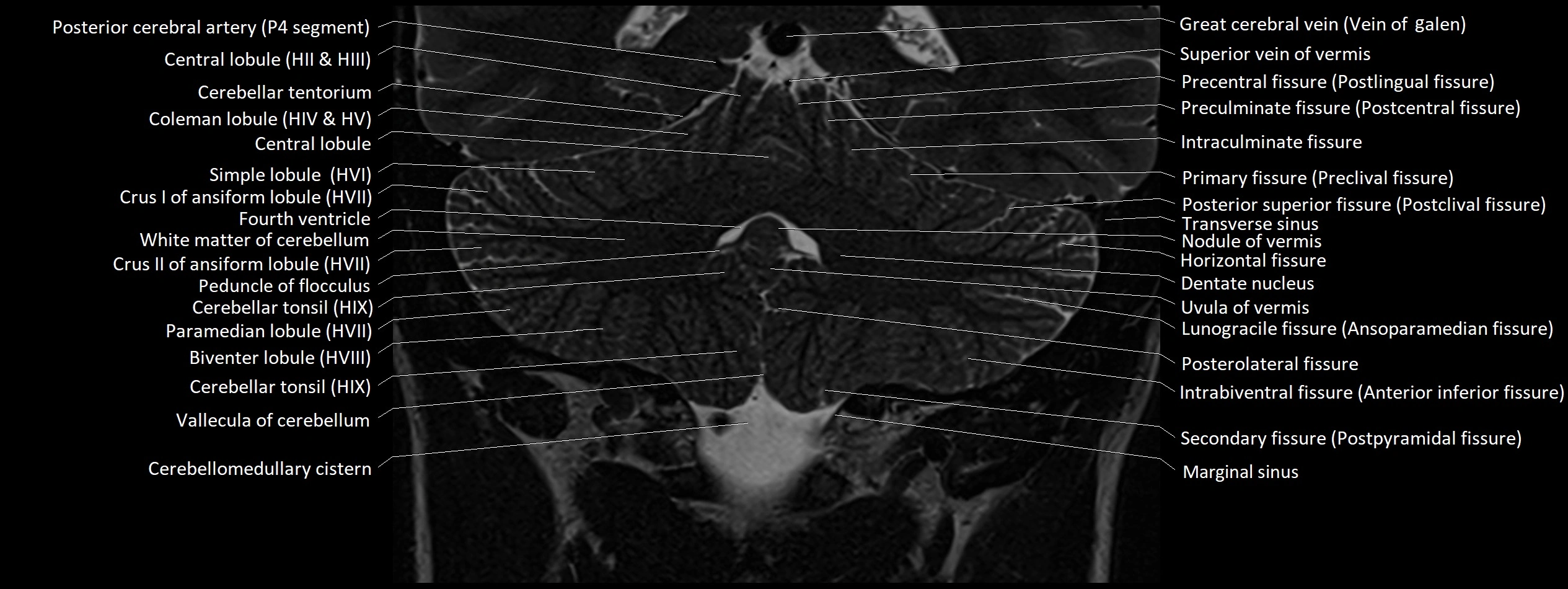 Anatomy of cerebellum coronal cross sectional 3T image 12.webp